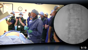 Lumbar Transforaminal