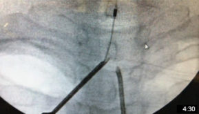 The RX-2 Coude Needle for better SCS Placement