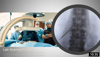 Scarring Triangle Procedure