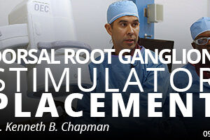 Dorsal Root Ganglion Stimulator Placement