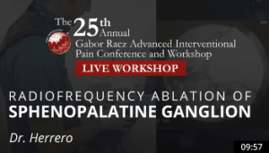 Herrero - Radiofrequency Ablation of Sphenopalatine Ganglion
