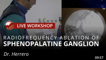 Herrero – Radiofrequency Ablation of Sphenopalatine Ganglion
