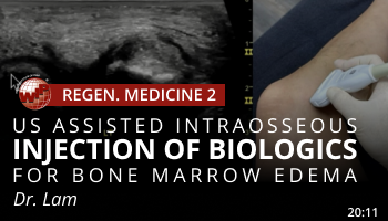 Lam – US assisted intraosseous injection of biologics for bone marrow edema