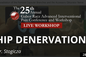 Stogicza - Hip Denervation