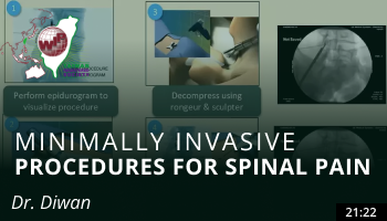Minimally Invasive Procedures for Spinal Pain