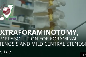 Extraforaminotomy: Simple Solution for Foraminal Stenosis and Mild Central Stenosis