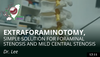 Extraforaminotomy: Simple Solution for Foraminal Stenosis and Mild Central Stenosis